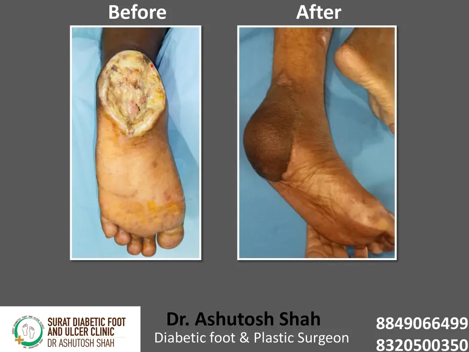 Diabetic Foot  PPT sunita.pptx-25.webp